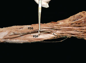 Anterior aspect of the left forearm. FDS: flexor digitorum super-ficialis, FDP: flexor digitorum profundus. Black arrow indicates the FDP tendon originating from the FDS muscle