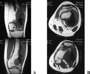 Magnetic resonance images demonstrating the tumor expansion process (osteosarcoma) in the distal metaphysis and epiphysis of the left femur and affecting soft tissues (extra-compartmental). Coronal (A) and axial (B) T1 images