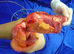 Intraoperative photograph showing a wide tumor resection in the distal region of the left femur