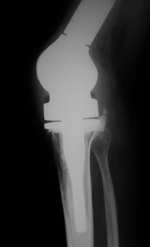 Radiograph showing a lateral view of the knee region, in which osteoarticular substitution using an unconventional modular endoprosthesis can be seen