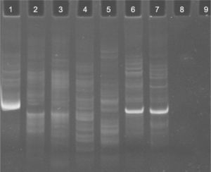 Clonality analysis of a polyacrylamide gel following electrophoresis of PCR products using the IgH Nizet protocol. Lane 1: positive control; lanes 2, 3, 4 and 5: polyclonal results (cases 2 and 4 in duplicate); lanes 6 and 7: monoclonal results (case 13 in duplicate); and lanes 8 and 9: undefined results (case 17 in duplicate)