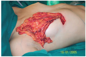 The omentum flap on the thoracic wall.