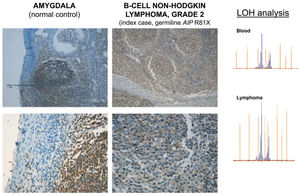 Maintenance of heterozygosity and positive AIP immunostaining in the B-cell non-Hodgkin lymphoma of the R81X AIP mutated IFS patient.
