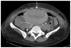 Grade III–IV hydronephrosis (thick dashed arrow) and ureter obstruction (thin solid arrow).