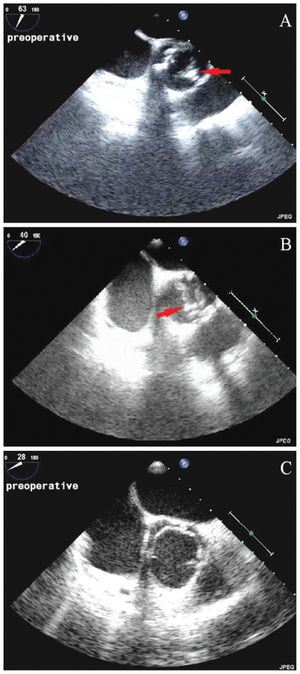 Short axis views from intraoperative transesophageal echocardiography. (A) Type A bicuspid aortic valve with two commissures at 2 and 8 o’clock and a raphe (arrow) at the 5 o’clock position. The anterior leaflet and the raphe are calcified. (B) Type B bicuspid aortic valve with two commissures at 5 and 11 o’clock and a raphe (arrow) at the 7–8 o’clock position. Both leaflets and the raphe are calcified. (C) Type C bicuspid aortic valve with two commissures at the 3–4 and 9 o’clock positions with no raphe. The leaflets were free of calcification.