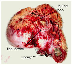 The jejunal loop enclosing the sponge, adhered to a segment of ileal bowel.