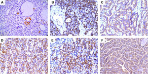 Immunohistochemical expression of NDRG1 in thyroid lesions. A. Nodular goiter; original magnification, 400×. B. Follicular adenoma; original magnification, 400×. C. Classical papillary thyroid carcinoma; original magnification, 400×. D. Follicular variant of papillary thyroid carcinoma; original magnification, 400×. E. Follicular carcinoma; original magnification, 400×. F. Metastatic classical papillary thyroid carcinoma; original magnification, 200×.