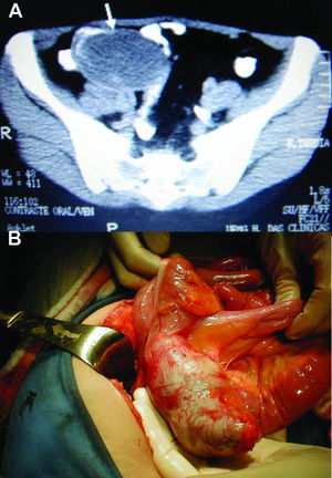 A) CT scan showing a well-encapsulated cystic mass in the right lower quadrant (arrow); B) Mucocele of the appendix.