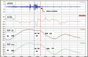 Graphical depiction of the signals that were obtained from surface electromyography (sEMG), accelerometry sensor (ACEL), and inductive respiratory plethysmography (RIP) measurements in patients who swallowed 10 mL of water.- Graphical depiction of the signals that were obtained from surface electromyography (sEMG), accelerometry sensor (ACEL), and inductive respiratory plethysmography (RIP) measurements in patients who swallowed 10 mL of water. Notes: Respiratory phases: inspiration (IN), expiration (EX), respiratory pause (RP), plethysmography rib cage (RIP rib), and plethysmography abdomen (RIP abd).