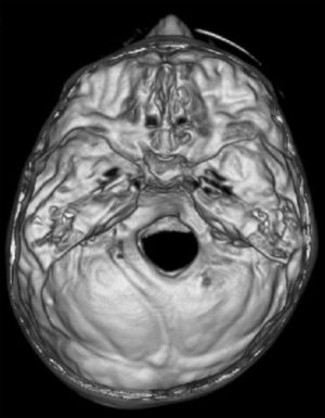 A 3 D reconstruction CT scan showed skull asymmetry in a 14-year-old patient (deformational plagiocephaly) without synostosis. A 3D reconstruction CT scan of the endocranial base showed asymmetric 3D position of the external acoustic meatus. The asymmetry is more marked in the middle and the posterior cranial fossa while the anterior cranial fossa was slightly asymmetric.