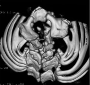 A 3 D reformatted CT scan showed Spin bifida occulta and extensive malsegmentation along the posterior spine elements are associated with bilateral rib intrinsic anomalies including partial fusion, broadening, and bifid rib in the same child.