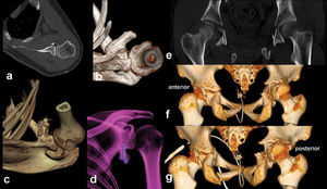 3D image can reveal even minor osseous abnormalities. In a patient with Bankart lesion, axial (a) and 3D image (b) show displaced osseous anterior glenoid rim. Six months after repairing with coracoid transfer, loosening of metallic screw is seen in the operation area,in VR-3D (c) and semitransparent 3D (d) images. In another case with severe pelvic trauma, although coronal plan image (e) shows derangement of the right hip, anterior (f) and posterior (g) 3D images show the displacement of the hip rather than just a fragmented fracture.3D images were, also, explanatory and drew attention to the left hip (with displaced fractures of acetabulary contours).