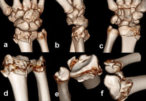 Radial head fracture. It is possible to exarticulate the superposed osseous contours virtually step by step (from image a to image f) with these systems in order to delineate intra-articular fracture lines.