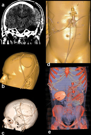 Cranial trauma. a) Cerebral herniation from the defect in the left parietal area. b) All drainage tubes, catheters and the defect area can be seen in different 3D Windows (b, c). In the same patient it was also detected the abdominal catheters (drainage tubes, gastrostomy tube, d) and buried calvarium in the abdominal wall (e).