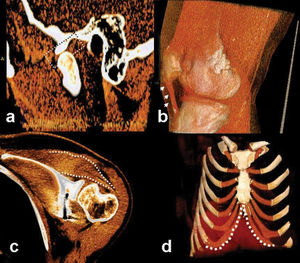 Extraosseous findings in some cases who were not convenient for MRI. It is possible to see the menisci (temporomandibular joint disc, dashed rectangular in a) and muscles (supra and infraspinatus, dashed lines in c) in thick slab colored VR images. Also with 3D images, we can see tendons (patellary tendon, small arrows in b) and cartilage (costal arch, dashed lines in d) structures.