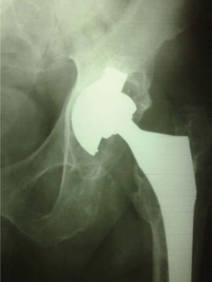 A PCA acetabular component with signs of definitive loosening.