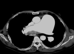 A contrast-enhanced spiral CT scan showing an eccentric filling defect along the lateral margin of the right pulmonary artery. The patient was a 53-year-old male with schistosomiasis, pulmonary hypertension and lung vessel remodeling.