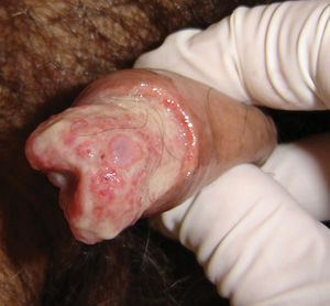 A penile lesion after dorsal incision of the foreshaft
