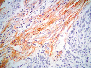 The intratumoral stroma (ITS) region of squamous cell carcinoma. A representative histologic section of the ITS region of a squamous cell carcinoma sample containing fibroblast-like cells positive for podoplanin expression is shown. (Immunohistochemistry, D2-40, original magnification, 400×).