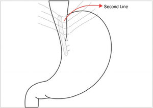 Making the background of fundoplication in the left lateral border.