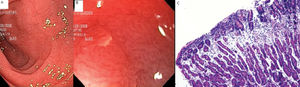 (A) Endoscopic image: Loss of duodenal folds. (B) Mucosa (100× magnification): villous atrophy, microhemorrhage with multiple erosions. (C) Histology: total villous atrophy, Marsh 3C (1).