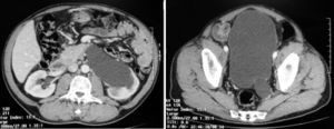 Computer tomography showing (A) dilated left upper urinary tract and (B) left megaureter close to the bladder.