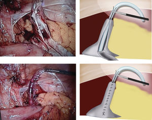 Longitudinal partial incision of the ureter over a 12-F catheter demonstrated in picture (A) and drawing (B). Megaureter tailored with a running suture over a 12-F catheter showed in (C) picture and (D) drawing. Note the forceps stabilizing the ureter.