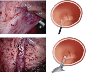 Submucosal tunnel being blunty dissected with 5mm laparoscopic Mixter forceps in (A) picture and (B) drawing. The tailored ureter positioned through the submucosal tunnel with the orifice sutured to the bladder mucosa showed in picture (C) and drawing (D).