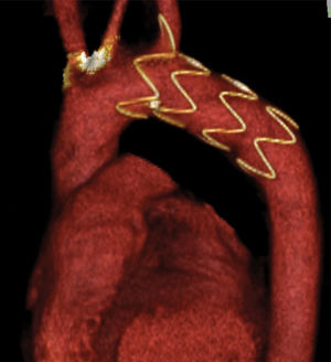 Migration of the uncovered stent (free-flow end of endograft) into the left subclavian artery.