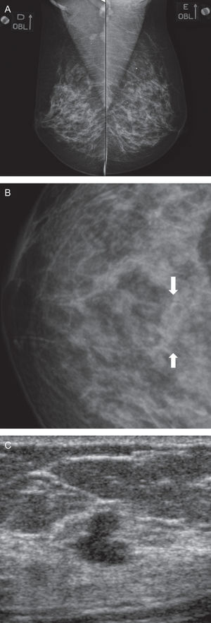 A-B - Oblique views of both breasts and a magnification of the central region of the right breast. A subtle round asymmetry is seen in the right breast (arrow in B), which was found to be a cyst (not shown). C. Additionally, US demonstrated an irregular mass, which was revealed to be Invasive Lobular Carcinoma by histology.