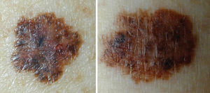 Macroscopic image of two melanocytic lesions whose characteristics are superimposed by the ABCD rule (asymmetry, irregular borders, varied coloration, diameter greater than 6 mm): Left - dysplastic nevus; Right – cutaneous melanoma.