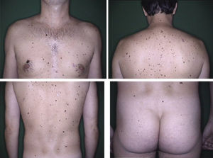 Body mapping of a male patient, 34 years of age, 256 nevi selected for follow-up. Presents 3 criteria for AMS: more than 100 nevi, presence of more than 2 clinically dysplastic nevi and nevi on the buttocks.