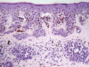Histopathologic exam of atypical nevus showing focal atypia of melanocytes, fusion of epithelial cones and concentric lamellar fibrosis. Optical microscopy image with high magnification (40X).