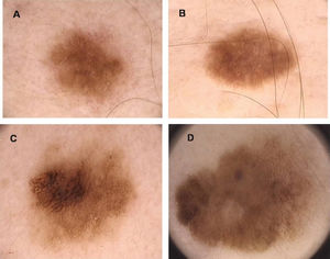 Digital dermoscopy (20X) of melanocytic lesions that have similar dermatoscopic appearance (A ∼ B; C ∼ D): A) compound melanocytic nevus; B) dysplastic nevus; C) dysplastic junctional nevus with severe atypia, D) thin melanoma.