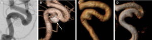 Post-embolization follow-up of a cavernous carotid artery aneurysm, in working-view incidences, classified in consensus by both readers as class II in Raymond scale. A: DSA of the internal carotid artery showing the residual neck of the treated aneurysm (class II). B: DSA with 3D reconstruction delimiting the aneurysm residual neck (class II) and the coil mesh (arrow). C: CE-MRA with volume-rendered reconstruction showing class II recanalization. D: TOF-MRA with volume-rendered reconstruction showing class II recanalization.
