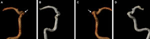 An internal carotid artery aneurysm with a small neck remnant identified by DSA and CE-MRA but not visible on TOF-MRA. A, B: CE-MRA, with volume-rendered reconstruction of the internal carotid artery, showing a small aneurismal neck remnant (arrow). C, D: TOF-MRA, with volume-rendered reconstruction of the internal carotid artery, without clear identification of the aneurismal neck.