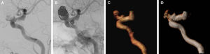 An ophthalmic aneurysm with an aneurismal remnant (class III), assuming a “helmet” type recanalization. A: DSA demonstrating aneurismal remnant partially superimposed by the coil mesh. B: Angiography, without subtraction, showing the coil mass surrounding the aneurism recanalization. C: CE-MRA with volume-rendered reconstruction showing the aneurysm remnant without interposition of the coil mesh. D: TOF-MRA with volume-rendered reconstruction showing the aneurysm remnant without interposition of the coil mesh but with slight loss of signal in comparison to CE-MRA.