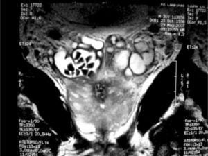Magnetic resonance imaging showing enlarged seminal vesicles with lithiasis.