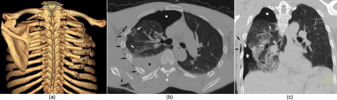 Human Rib Cage Injuries Thoracic Injuries in earthquake-related versus non-earthquake-related ...
