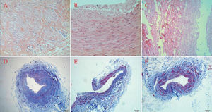 Hematoxylin and eosin staining showing (A) proliferative medial smooth muscle cells with inflammatory cell infiltration in the saphenous veins, (B) focal intimal degeneration with slight disrupted media in the radial arteries, and (C) roughly normal vascular wall structures of the internal mammary arteries; H&E ×200. Masson's trichrome staining showing that (D) the saphenous veins showed more collagen deposition but less muscular fibers, (E) the radial arteries showed less collagen deposition and more muscular tissues, and (F) the mammary arteries showed the least collagen accumulation in the vascular wall but the most muscular tissue; Masson ×100.