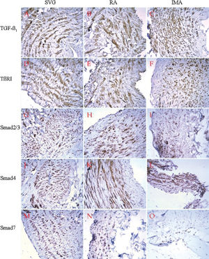 Immunostaining showed that the five tested proteins (TGF-β1, TβRI, Smad2/3, Smad4, and Smad7) were positive, primarily in the cytoplasm of the medial layers, in all three kinds of grafts. (A) (B) In the saphenous vein and radial arterial grafts, TGF-β1 expression was moderately positive (++) in the cytoplasm and interstices of the intima, intensely positive (+++) in the cytoplasm and interstices of the media, and weakly positive (+) in the cytoplasm and interstices of the adventitia. (C) In the intima (++), media (+++) and adventitia (+) of the internal mammary arterial grafts, TGF-β1 staining was only observed in the cytoplasm and not in the interstices. In the saphenous vein grafts, TβRI was moderately positive in the cytoplasm and interstices (+-++) of the intima, intensely positive (+++) primarily in the cytoplasm but also in the nuclei and interstices of the media, and weakly positive (+) or negative (-) in the cytoplasm or interstices, respectively, of the adventitia (D). This receptor was positive in the cytoplasm and interstices of the intima (+), media (++) and adventitia (+) of the radial arterial grafts (E), and positive in the cytoplasm of the intima (+), media (++) and adventitia (+) of the internal mammary arterial grafts (F). Smad2/3 positivity was more intense in the saphenous vein grafts (G) than in the internal mammary arterial grafts (I), whereas the radial artery (H) showed the least intense Smad2/3 staining. In the saphenous vein grafts, Smad4 was weakly positive (+) in the cytoplasm of the intima, intensely positive (+++) in the cytoplasm of the media, and weakly positive (–+) in the cytoplasm of the adventitia (J). In the radial arteries, it was weakly positive in the cytoplasm (+) and negative (-) in the intima, moderately positive (++) in the cytoplasm and interstices of the media, and weakly positive in the cytoplasm and interstices of the adventitia (K). In the internal mammary arteries, it was positive in the cytoplasm of the intima (+), media (++), and adventitia (+) (L). Smad7 was expressed most intensely in the saphenous veins (M), more intense in the radial arteries (N), and it was weaker in scattered nuclei and interstices in the internal mammary arterial grafts (O). IMA  =  internal mammary artery; RA  =  radial artery; SVG  =  saphenous vein graft; TGF-β1: transforming growth factor-β1; TβRI: transforming growth factor-β receptor-β receptor I. Envision ×200.