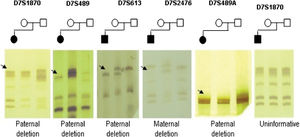Genotyping of the five microsatellites markers in WBS families. DNA fragments of those affected are always the first column of each gel followed by DNA from the mother and the last column the DNA of the father. Black arrows indicate allelic loss.