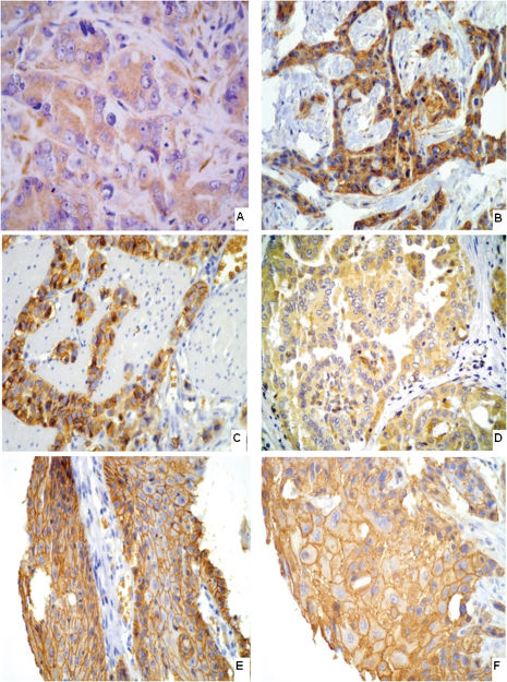 Glut1 Imaging GLUT1 expression in malignant tumors and its use as an immunodiagnostic ...