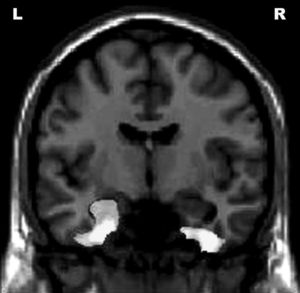 Correlations between Functional Activities Questionnaire scores and reduced gray matter volume in different areas of the brain. The results are displayed at an uncorrected p<0.001 level and plotted onto the SPM5 canonical T1 image for the purpose of illustration. R = right; L = left.