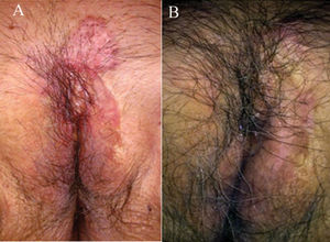 Extramammary Paget's disease. (A) Before treatment. Large hyperpigmented to pink plaque extending through the pubic area and left great labia. (B) After 25 weeks of treatment. Some biopsy scars are visible but there is no residual Paget's disease.