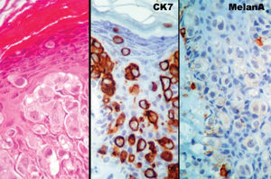 Histological presentation of the vulvar skin showing pleomorphic large cells, isolated or in groups, among normal keratinocytes (left). These cells stained for cytokeratin 7 (middle) and were negative for Melan-A (right), allowing the diagnosis of extramammary Pagets disease.