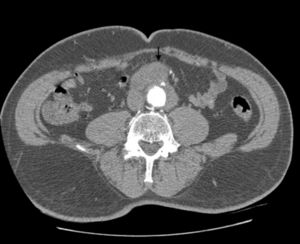 Computed tomography in the axial plane shows the chronic pseudoaneurysm of the infrarenal aorta.