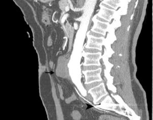 Computed tomography in the sagittal plane shows the pseudoaneurysm in the anterior aortic portion (arrow) and a metalic fragment impacted in S1 (arrowhead).