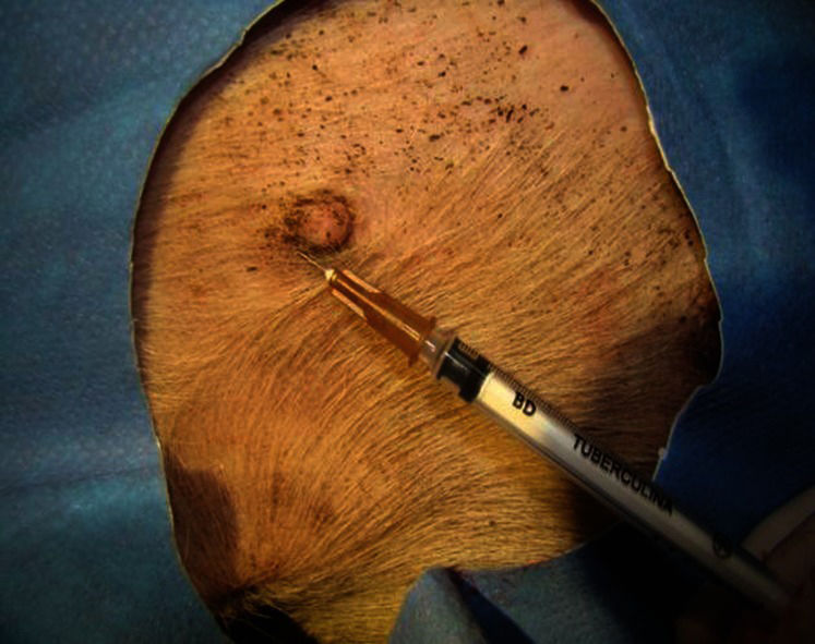 Subaerolar Injection The impact of previous para-areolar incision in the upper outer ...