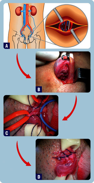 Microsurgical Subinguinal Varicocele Repair. A) A transverse incision is made just below the level of the external inguinal ring. B-D) Intraoperative photographs of the spermatic cord. B) Dilated cremasteric veins are identified by elevating the spermatic cord with a Babcock clamp. C) Testicular artery (blue vessel loop), lymphatics (blue cotton suture), and dilated varicose veins (red vessel loops) are demonstrated. D) Final surgical aspects of the varicose veins are transected and ligated with nonabsorbable sutures.
